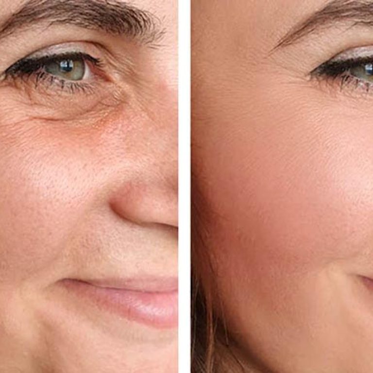 24018-non-surgical-facelift-1