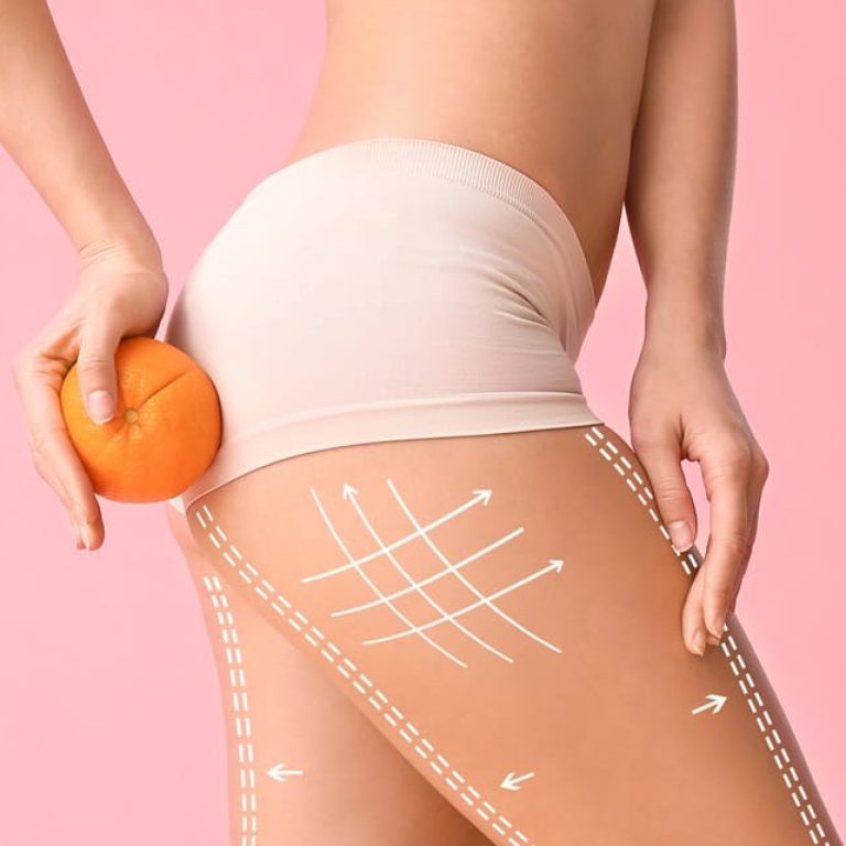 Cellulite