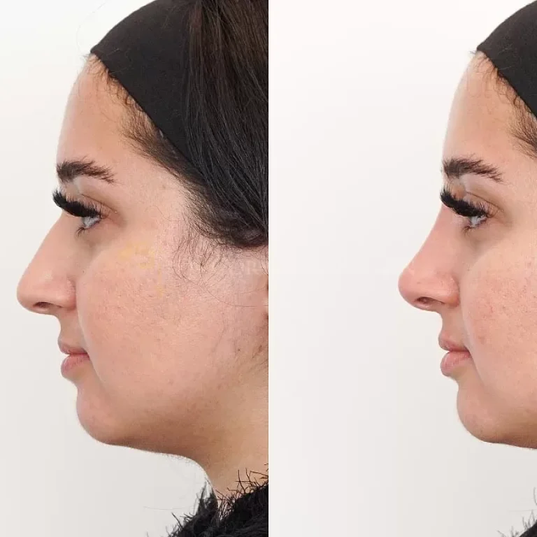 Non-Surgical-Nose-Job-Before-After-P17-1