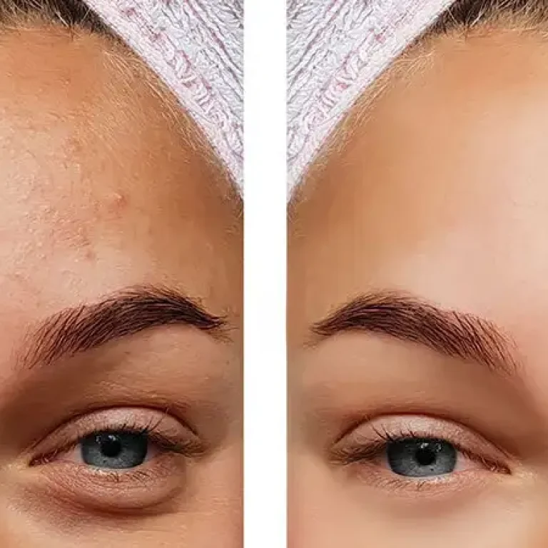 acne-1080x