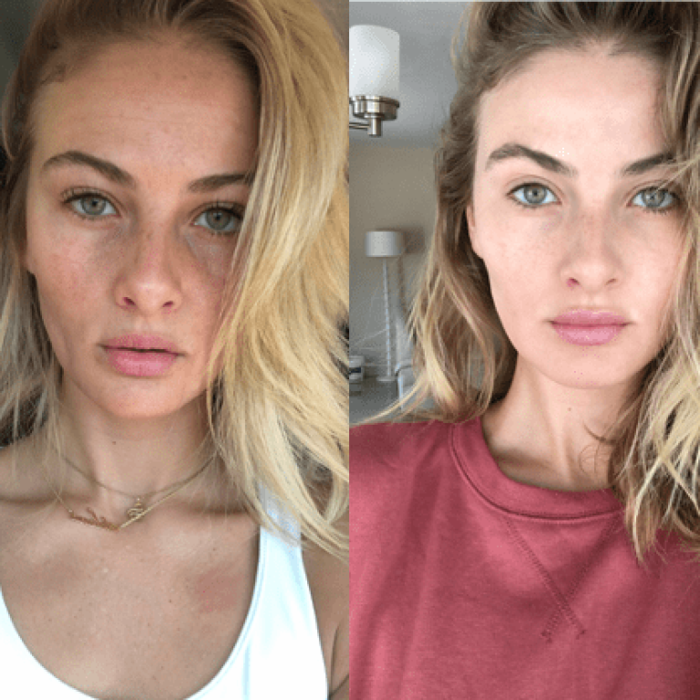 nps_before-after-tear-trough-fillers-min